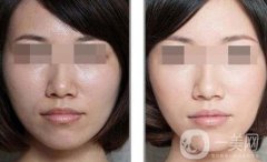 彩光嫩膚要多少錢？彩光嫩膚價(jià)格需要多少？