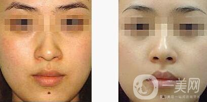 光子嫩膚適合人群有哪些？光子嫩膚不適合哪些人？