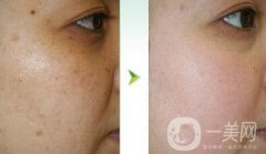 光子嫩膚調(diào)節(jié)黃褐斑果怎么樣？去黃褐斑圖