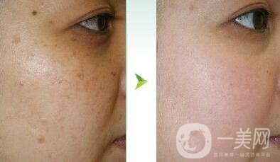 光子嫩膚調(diào)節(jié)黃褐斑*果怎么樣？去黃褐斑圖