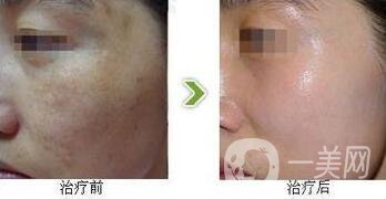 光子嫩膚調(diào)節(jié)黃褐斑*果怎么樣？去黃褐斑圖