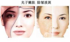 光子嫩膚如何護理？光子嫩膚的注意事項