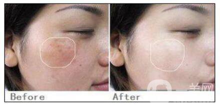 c6激光祛斑多少錢一次？c6激光祛斑價(jià)格詳解