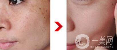 c6激光祛斑多少錢一次？c6激光祛斑價(jià)格詳解