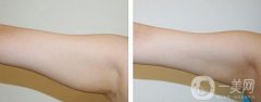 上臂吸脂減肥術(shù)要多少錢？手臂吸脂價格多少？