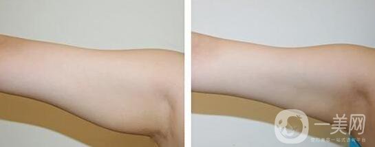 上臂吸脂減肥術(shù)要多少錢？手臂吸脂價(jià)格多少？
