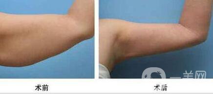 上臂吸脂減肥術(shù)要多少錢？手臂吸脂價(jià)格多少？