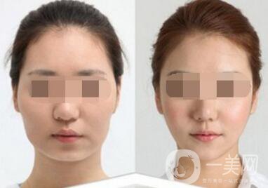 去頰脂墊要多少錢？去頰脂墊價格詳解