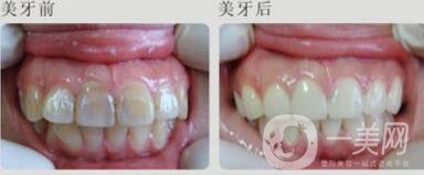 四環(huán)素牙怎么變白？四環(huán)素牙怎么辦？