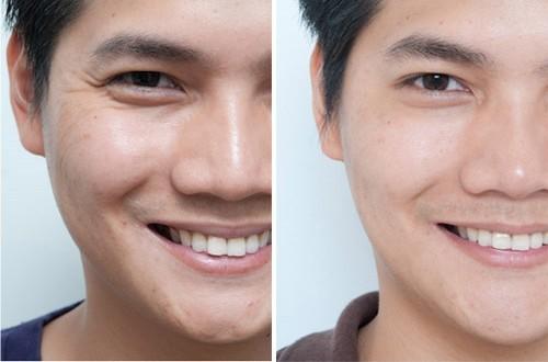 去魚尾紋的方法有哪些？玻尿酸去魚尾紋怎么樣？