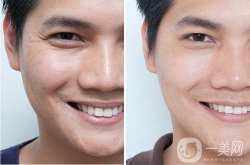 去魚尾紋的方法有哪些？玻尿酸去魚尾紋怎么樣？