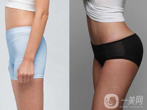 臀部共振吸脂手術(shù)價(jià)格是多少？怎么選擇吸脂醫(yī)生？