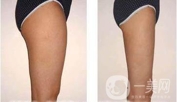 臀部共振吸脂手術(shù)價(jià)格是多少？怎么選擇吸脂醫(yī)生？