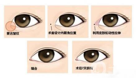 韓式開眼角多少錢？價格很貴嗎？