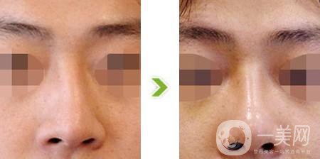 歪鼻矯正費(fèi)用大概是多少？?jī)r(jià)格影響因素有哪些？