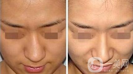 烤瓷牙有哪些種類？多久可以恢復(fù)？