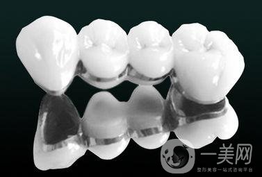 烤瓷牙有哪些種類？多久可以恢復(fù)？