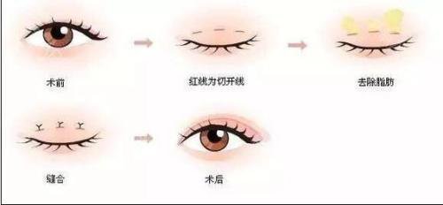 焊接雙眼皮是什么？手術后多久能好？