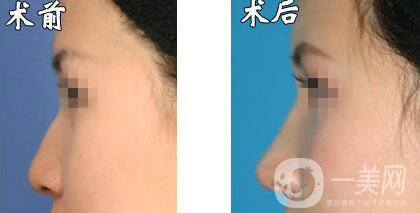 瑞蘭玻尿酸隆鼻價(jià)格需要多少?所需費(fèi)用詳解