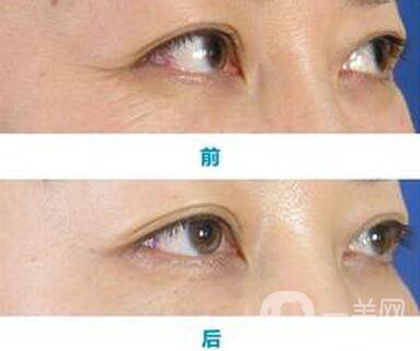 怎樣去魚尾紋*果好？去除魚尾紋的方法介紹