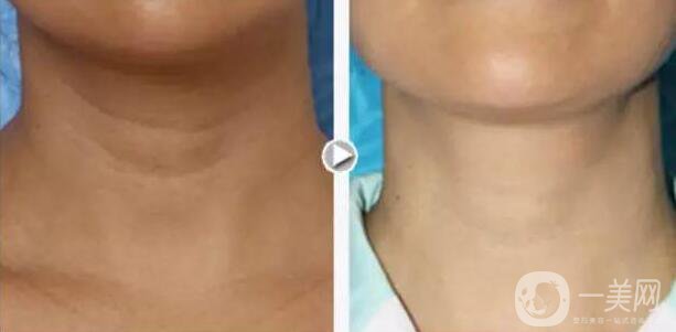 有頸紋怎么辦？去頸紋什么方法好？