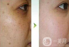 去蝴蝶斑用什么方法好？蝴蝶斑調(diào)節(jié)方法詳細(xì)介紹