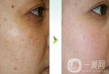 去蝴蝶斑用什么方法好？蝴蝶斑調(diào)節(jié)方法詳細(xì)介紹