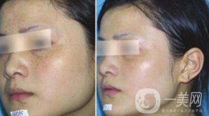 去蝴蝶斑用什么方法好？蝴蝶斑調(diào)節(jié)方法詳細(xì)介紹