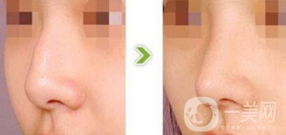 駝峰鼻矯正需要多少錢？駝峰鼻矯正費用詳解