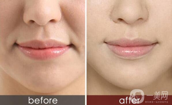 怎么除去法令紋？什么方法可以去法令紋？