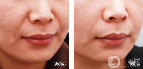 法令紋怎樣消除*果*好？該怎么樣做？