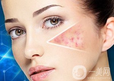 像素激光去痘坑*果怎么樣？怎樣很好的調(diào)節(jié)*果？