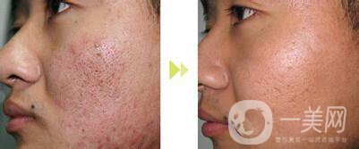 像素激光去痘坑*果怎么樣？怎樣很好的調(diào)節(jié)*果？