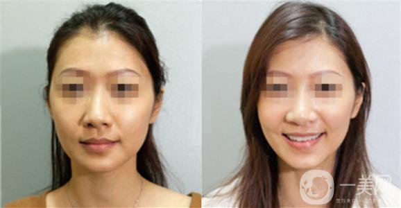 做黑臉娃娃的副作用有哪些？可以避免嗎？