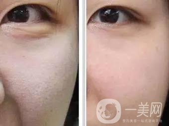 果酸換膚后注意事項盤點大揭秘，該怎么做？