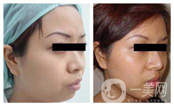 墊下巴一般用什么材料好？?jī)r(jià)格貴嗎？