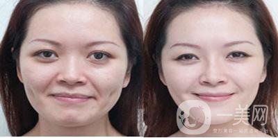 怎樣去鼻唇溝？哪些方法比較好？