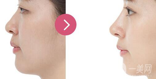 隆鼻什么材料好?？隆鼻的材料有哪幾種？