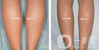 打**果嗎？注射*作用怎么樣？