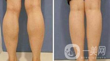 打**果嗎？注射*作用怎么樣？