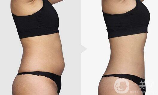 南京吸脂減肥的價格是多少？吸脂減肥大概多少錢？