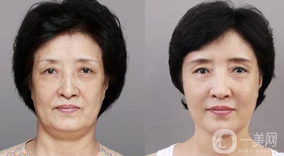 微創(chuàng)面部提升,價格