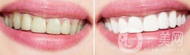 皓齒美白牙齒,多少錢(qián)