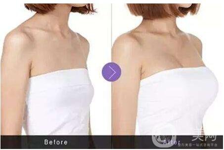 成都妙桃假體豐胸價格需要多少錢