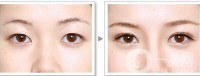 韓式三點(diǎn)雙眼皮能拆嗎？**果怎么樣？
