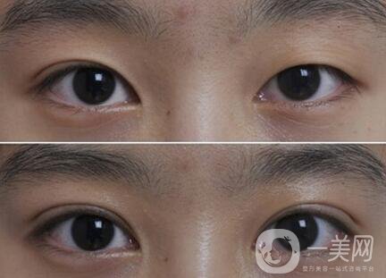 韓式三點(diǎn)雙眼皮能拆嗎？**果怎么樣？