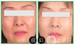 自體脂肪豐鼻唇溝果怎么樣?自體脂肪填充鼻唇溝詳細(xì)介紹