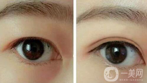韓式三點(diǎn)雙眼皮是埋線還是割？手術(shù)*果怎么樣