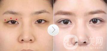韓式三點(diǎn)雙眼皮是埋線還是割？手術(shù)*果怎么樣