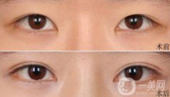 高分子埋線是*的嗎？可以維持幾年？